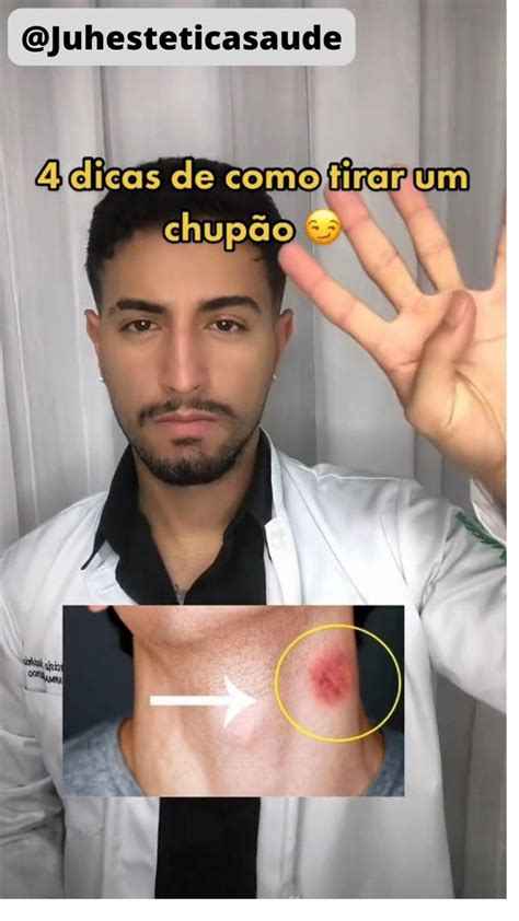 chupão no peito|Antes eu tinha uma mancha que parecia um chupão no pescoço,。